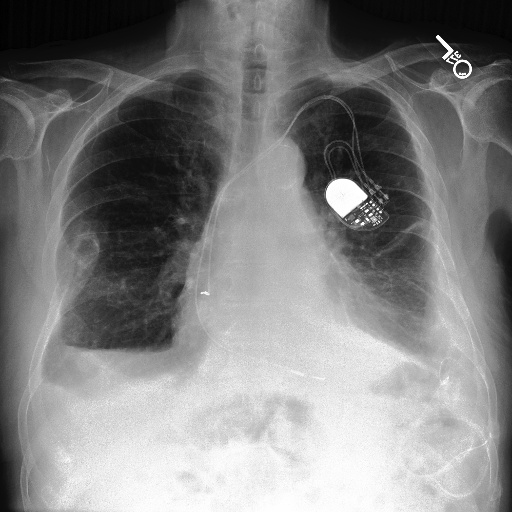 Chest X-Ray